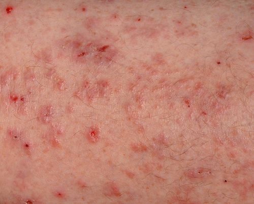 How Long Can Scabies Live In A Mattress How To Get Rid Of It