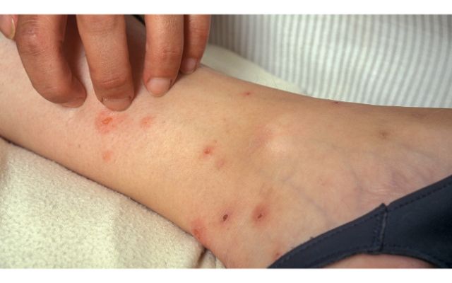 Bed Bugs Bites